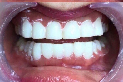 Hiểm hoạ từ răng phun sứ nano