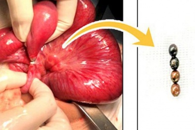 Bé gái bị tắc ruột, thủng nhiều lỗ vì nuốt 4 viên bi nam châm