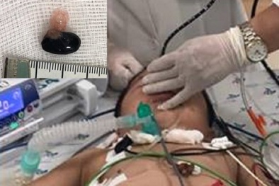 Hóc hạt mãng cầu, bé trai 3 tuổi nguy kịch: Kinh nghiệm sống còn với người lớn