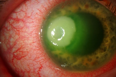 Trẻ em thường xuyên uống nước có khuẩn mủ xanh nguy hiểm như thế nào?