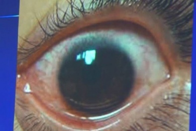 Cô gái suýt thủng giác mạc vì hay dùng điện thoại dưới trời nắng