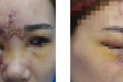 Cô gái 27 tuổi hỏng một mắt sau khi tiêm filler nâng mũi