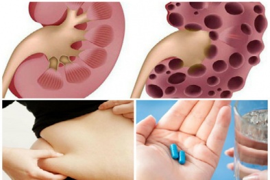 Cảnh báo: Nhiều trường hợp bị suy thận do uống thuốc ‘giảm cân thần tốc’