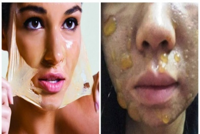 Bỏng nặng toàn khuôn mặt sau khi dùng mỹ phẩm peel da để lột da mặt