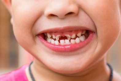 Bé 3 tuổi bị mủn nát 16 chiếc răng vì thói quen nhiều cha mẹ Việt mắc phải