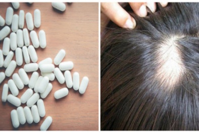 Dùng thuốc finasterid chữa rụng tóc nguy cơ xuất hiện hành vi tự tử