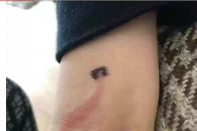 Bà mẹ cứu con trai khỏi bệnh nhiễm trùng huyết từ một dấu hiệu ở cánh tay