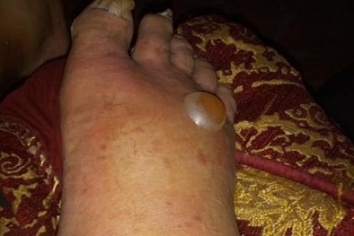 Người đàn ông bị nhiễm trùng da khủng khiếp sau khi nhúng chân vào nước trong công viên