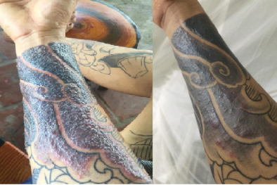 16 người bị nhiễm trùng nặng nghi do mực xăm: Có hay không bồi thường cho xong việc?