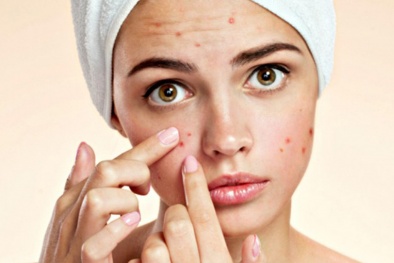 Cân nhắc kỹ khi bổ sung thực phẩm chức năng DIM hỗ trợ trị mụn trứng cá