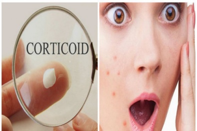 Mỹ phẩm chứa corticoid- tác dụng ‘thần tốc’ nhưng nguy hiểm khó lường