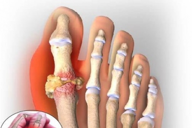 Những thực phẩm cần lưu ý khi sử dụng nếu bị bệnh gút