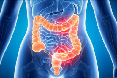 Thuốc kháng sinh có thể làm tăng nguy cơ ung thư ruột