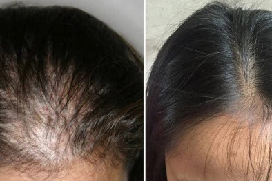 Thuốc chống rụng tóc có thực sự hiệu quả như tin đồn?