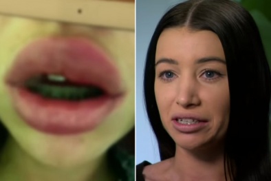 Bác sĩ thẩm mỹ cảnh báo chất làm đầy môi có thể khiến người dùng bị mù