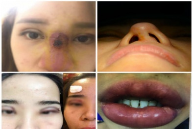Những ‘phốt’ đi thẩm mỹ viện khiến khách hàng ‘dở khóc dở cười’
