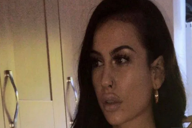 Cô gái 24 tuổi bị hỏng môi trầm trọng vì chất làm đầy