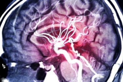 Sự ra đời của hệ thống AI với khả năng dự đoán động kinh gần như hoàn hảo