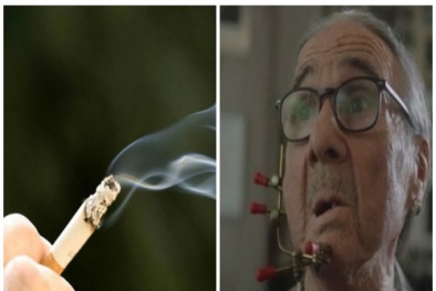 Biến dạng khuôn mặt vì ung thư lưỡi do hút thuốc lá nhiều năm liền