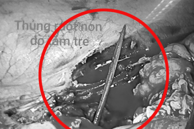 Thủng ruột do thói quen ngậm tăm tre xỉa răng sau ăn