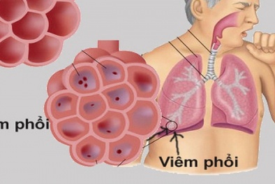 Chủ động phòng chống viêm phổi cấp có nguy cơ xâm nhập vào Việt Nam