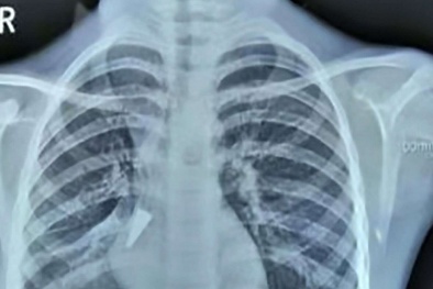 Bé gái vô tình nuốt nắp bút kim loại bị mắc vào phổi 