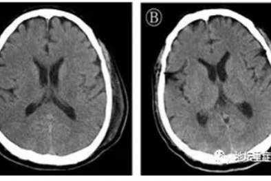Tìm thấy bằng chứng đầu tiên về việc virus corona tấn công hệ thần kinh trung ương