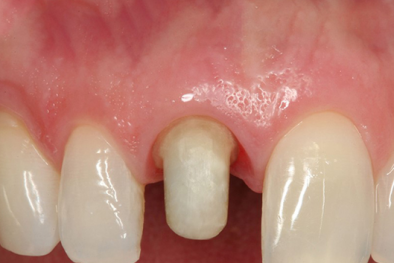 Bọc răng sứ mài nhỏ và những biến chứng nguy hiểm không thể lường trước