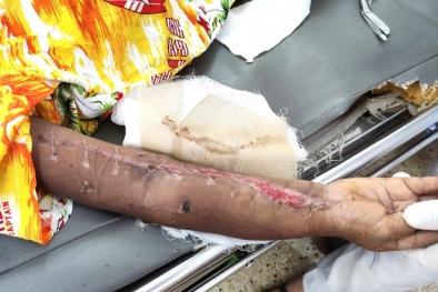 Gia đình tự ý tháo bột rồi đắp lá thuốc lên cánh tay khiến trẻ 4 tuổi suýt tử vong