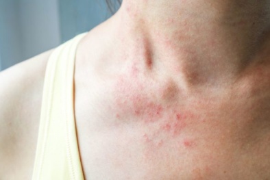 Xuất hiện triệu chứng mới do virus corona gây ra