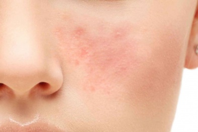 Các loại thuốc 'khắc tinh' của bệnh trứng cá đỏ nên tránh lạm dụng