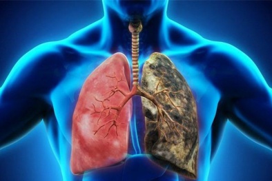 Nhóm thực phẩm quen thuộc hàng ngày có thể là 'sát thủ tàn phá' lá phổi nhanh chóng