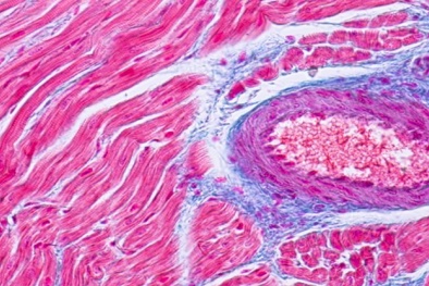 Nhiễm Covid-19 có gây tổn thương nặng nề cho tim?