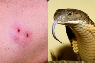 Bác sĩ cảnh báo sai lầm nghiêm trọng khi sơ cứu người bị rắn cắn