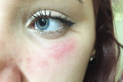 Da mặt dễ dị ứng mỹ phẩm ngày nắng nóng do sai lầm của người dùng