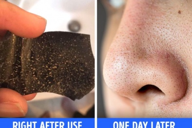 Đừng vội vàng sử dụng miếng lột mụn nếu chưa biết tới 6 điều này