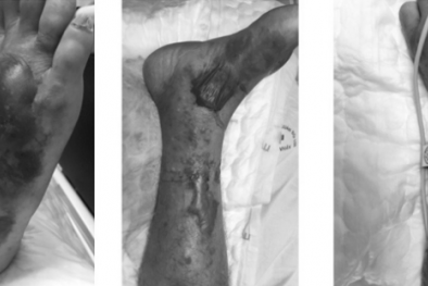 Ăn hải sản chưa chín kỹ bị hôn mê, suy đa tạng thậm chí tử vong