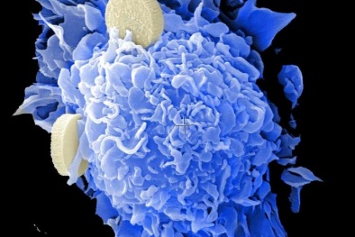 'Tiêu diệt' tế bào ung thư ngay trong cơ thể người với chất béo?