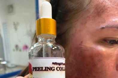 Tự bôi thuốc lột da peeling collagen trị nám khiến khuôn mặt phù nề, cháy đen xì