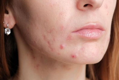 Sai lầm khi dùng thuốc chữa mụn trứng cá đỏ nhiều người dùng mắc