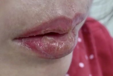 Xăm môi thẩm mỹ- nguy cơ tai biến rất cao chị em nên cân nhắc kỹ