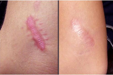 Trị sẹo lồi bằng phương pháp tiêm K-cort, diệt sẹo tận gốc