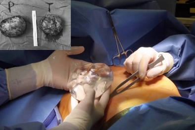 Cảnh báo vỡ túi độn ngực ở những người 'nâng cấp' vòng 1