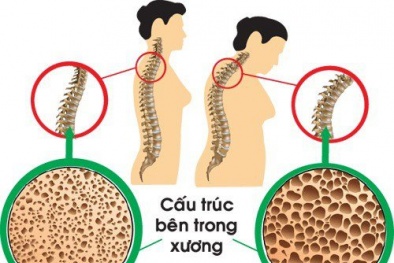 Cảnh báo: Người dùng thuốc corticosteroid trị hen suyễn có nguy cơ bị loãng xương