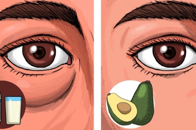 Tránh xa những thực phẩm có thể gây sưng và thâm mắt