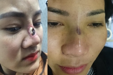 Thủng mũi sau làm đẹp bằng cấu trúc bọc Megaderm 