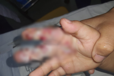 Cảnh báo tổn thương nghiêm trọng do phỏng điện ở trẻ nhỏ