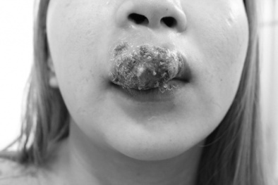 Môi sưng mọng chảy mủ sau xăm môi khiến cô gái phải nhập viện điều trị