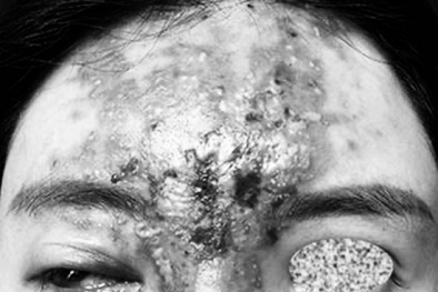 Mũi hỏng nặng sau tiêm filler tại một spa do người quen giới thiệu