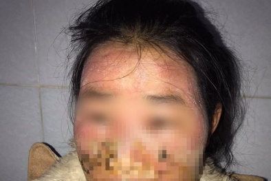 Bị lở loét hết mặt do sử dụng kem trộn không rõ guồn gốc 